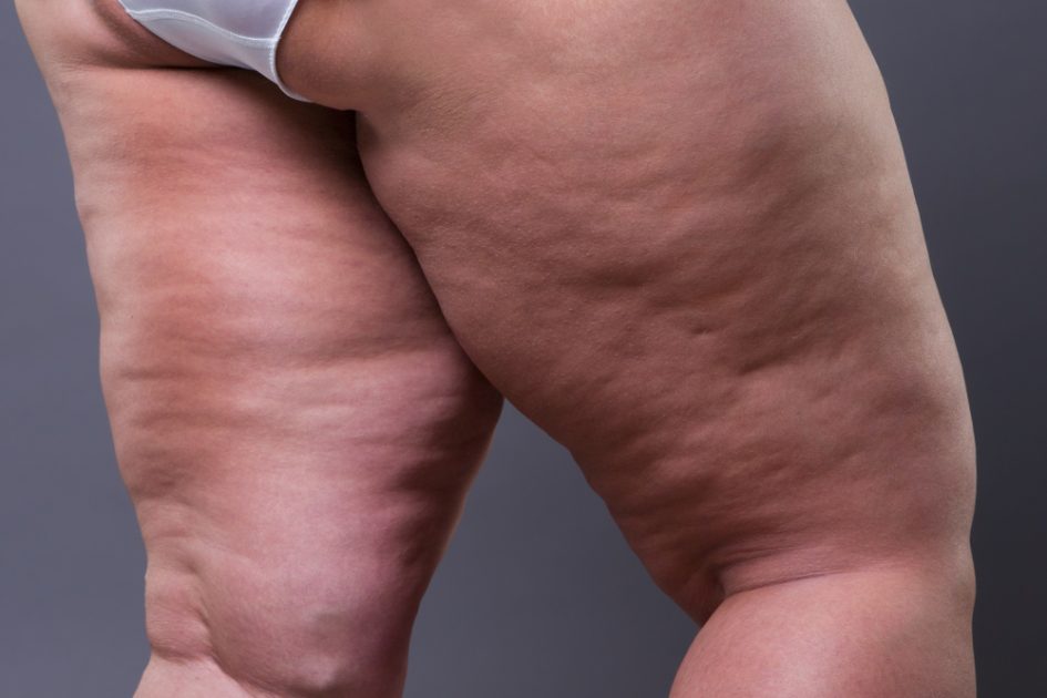 Do I Have Lipedema?