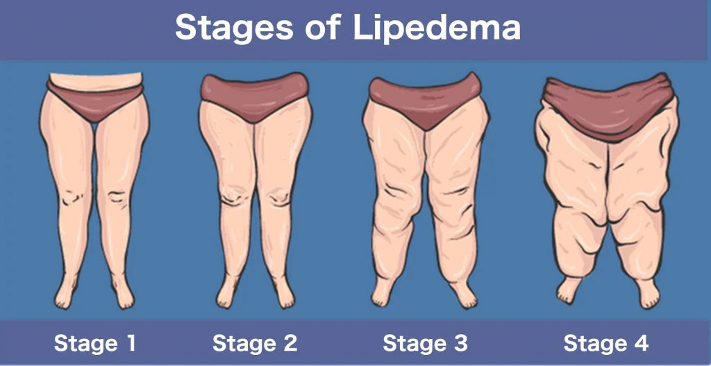 What is Lipedema (Fluid In The Fat)?