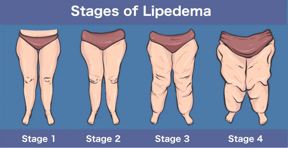 Where Does Lipedema Fat Gather?