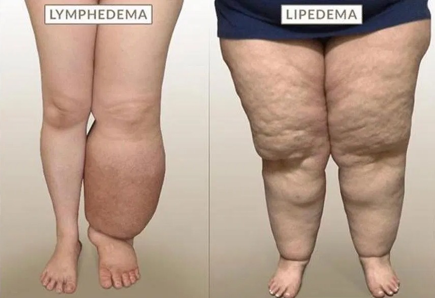 Lipedema Symptoms vs. Lymphedema Symptoms