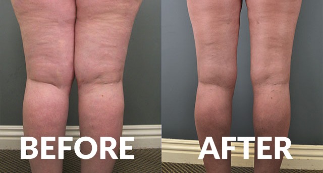 Lipedema Treatment With Liposuction Before And After Photos