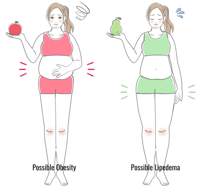 Lipedema vs. Obesity Using BMI