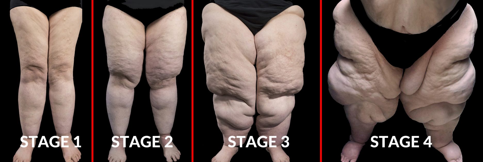 What Causes Lipedema?